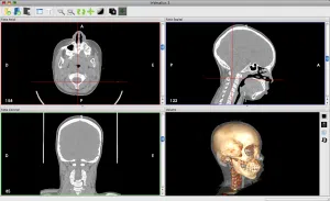 Skärmbilder av medicinska avbildningar och en 3D-modell av en skalle.